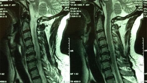 IRM du service cervical
