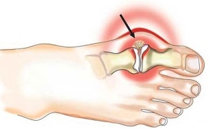 Inflammation de l'articulation entre le pouce et le pied dans l'arthrite