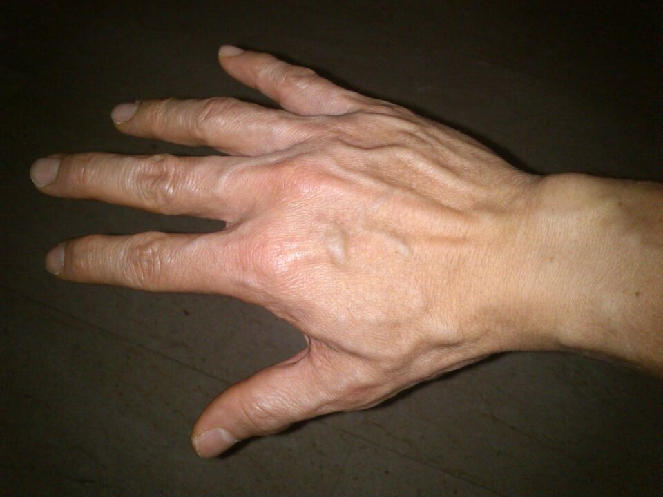 déformation des os et douleur dans les articulations des doigts